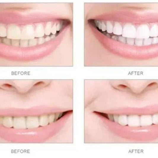 HiSmile V34™ : Révélez Votre Sourire le Plus Éclatant